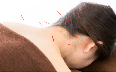 保険を使った鍼灸の治療